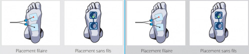 placement electrode-tendinopathies-aponevrosite-fasciite-plantaire